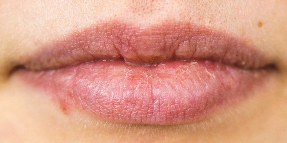 What are the best natural remedies for dry lips?