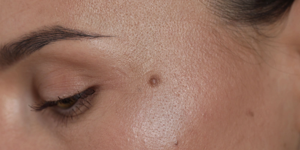 How can I reduce skin pigmentation naturally?