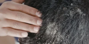 What are the best natural remedies for itchy scalp?