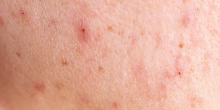 What are the best natural remedies for rough elbows?