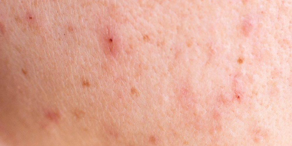 What are the best natural remedies for rough elbows?